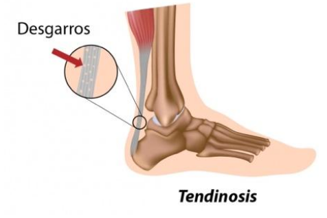 Tendinitis en Jerez
